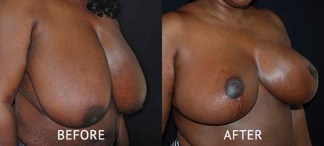 breast reduction surgery before and after photos