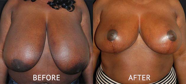 breast reduction surgery before and after photos