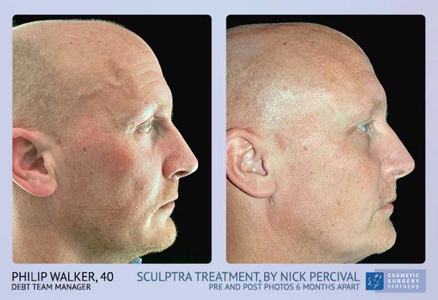 Male Sculptra treatment before and after photos