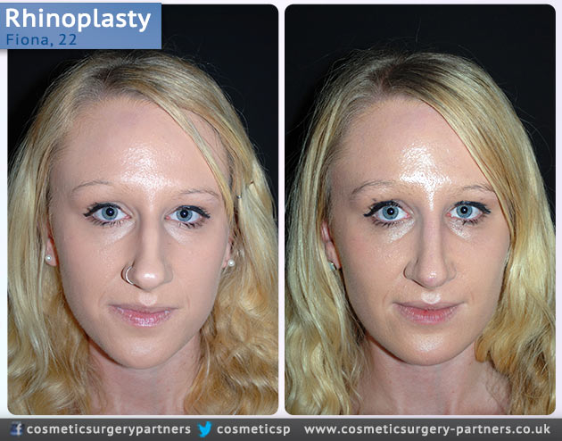 Rhinoplasty patient case studies