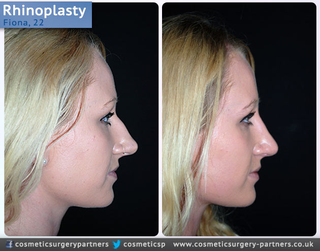 Rhinoplasty patient case studies