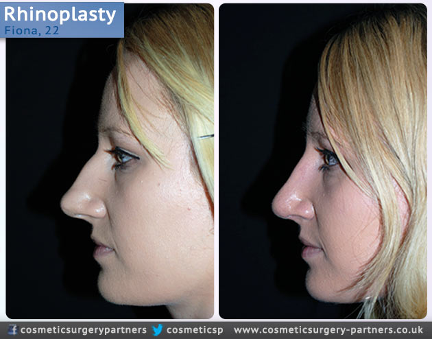 Rhinoplasty patient case studies