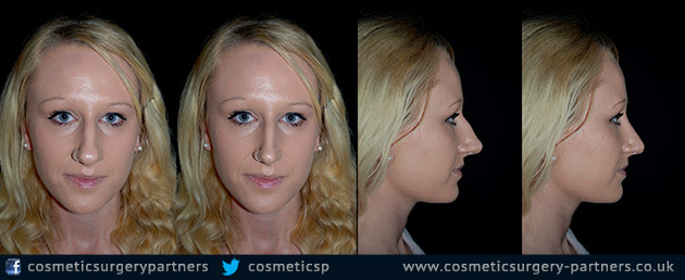 Rhinoplasty patient case studies