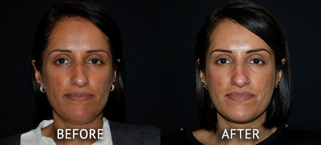 Obagi patient at cosmetic surgery partners before and after front view