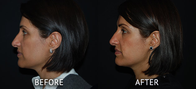 Obagi patient at cosmetic surgery partners before and after left side view