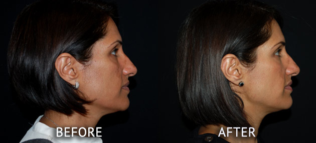 Obagi patient at cosmetic surgery partners before and after right side view