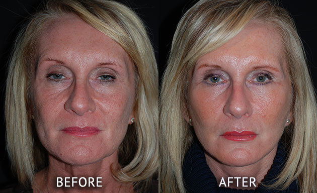 Face Lift patient at cosmetic surgery partners before and after front view