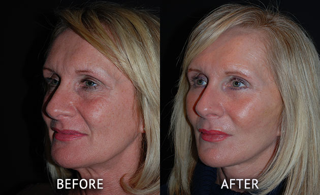 face lift before and after photos