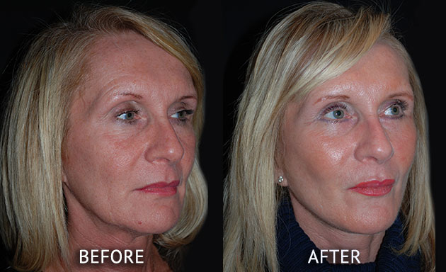 Face lift patient before and after photos