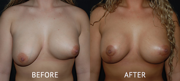 uneven breast correction surgery before and after