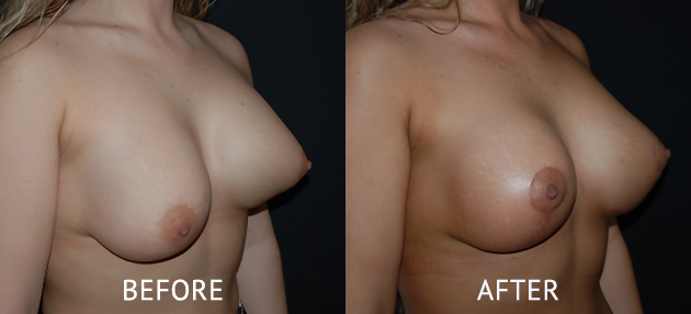 uneven breast correction surgery before and after cosmetic surgery photos