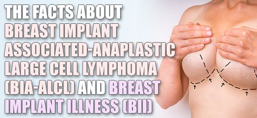 Breast Implant Safety Information – The Facts and Myths Concerning BIA-ALCL  and BII