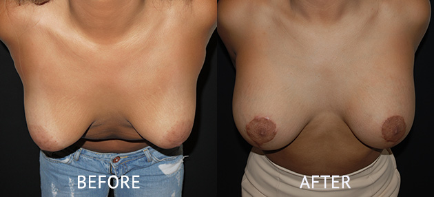 Breast Augmentation before after photo by Cosmetic Surgery Partners London Miles Berry 