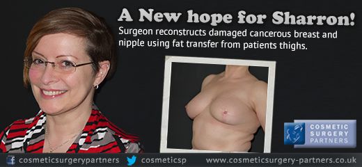 Cosmetic surgeon builds new breast & nipple for cancer patient via fat transfer from her thighs
