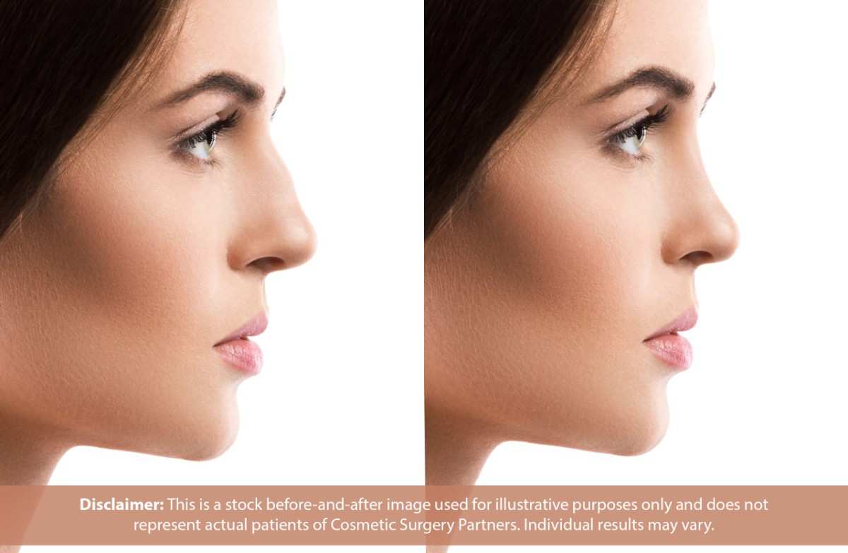 Side-by-side profile of a woman showing nose shape before and after.