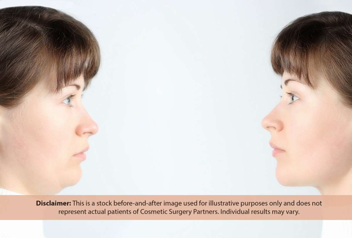 Two profile views of a woman before and after chin surgery.