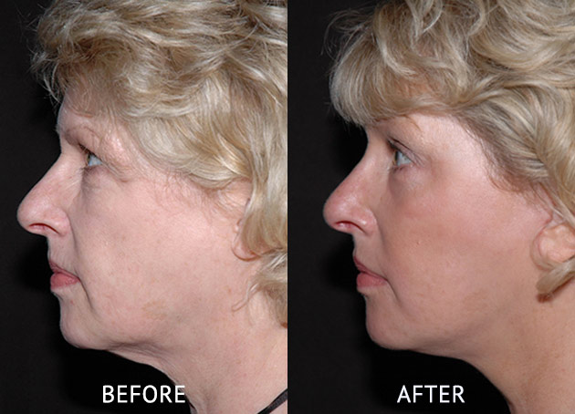 Facelift patient before after patient photo by Cosmetic Surgery Partners London
