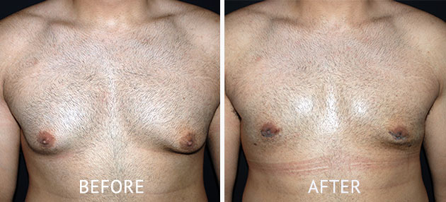 moob reduction surgery cosmetic surgery partners