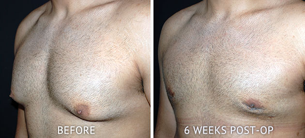 Gynecomastia patient before after surgery photos