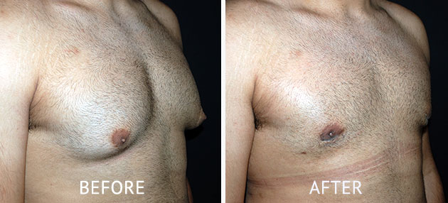 Gynecomastia before and after photos