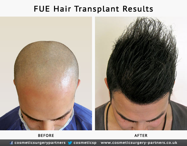  Hair Transplant Results at Cosmetic Surgery Partners London 
