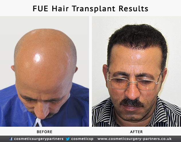  Hair Transplant Results at Cosmetic Surgery Partners London 
