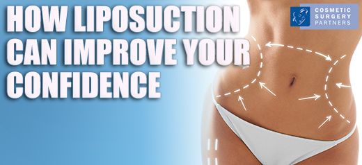 How Liposuction Can Help You Feel Confident in 2016