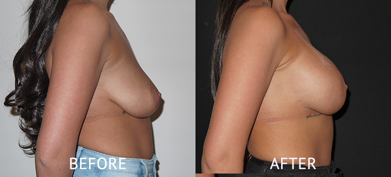 Before and 6 weeks after breast augmentation surgery photos