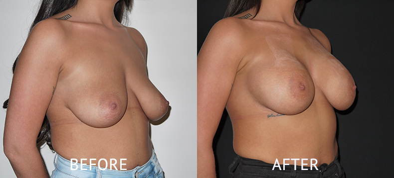 Before and 6 weeks after breast augmentation surgery photos