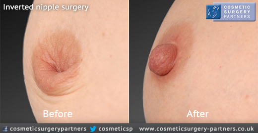 Inverted nipple correction at Cosmetic Surgery Partners London