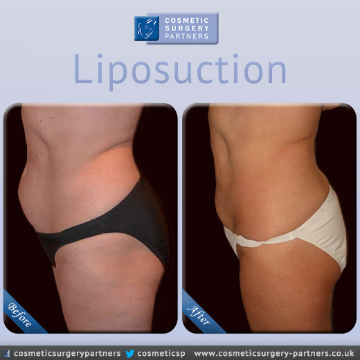 Liposuction at Cosmetic Surgery Partners London 