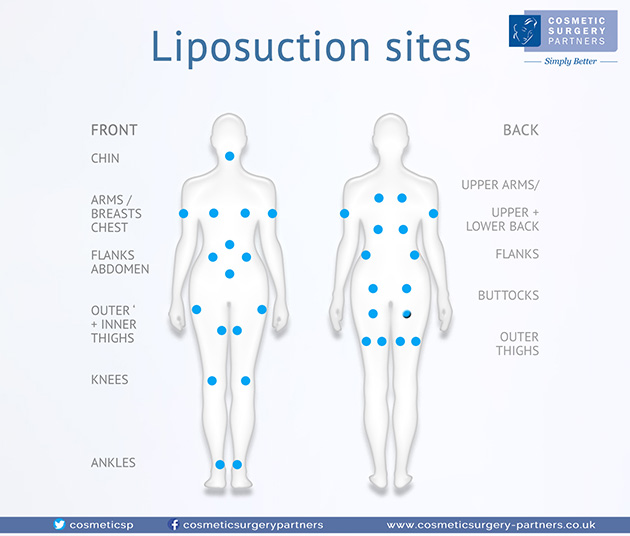 Image showing all possible areas of liposuction surgery  at Cosmetic Surgery Partners London