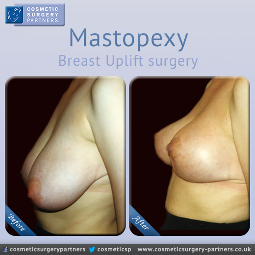 Mastopexy breast uplift surgery at Cosmetic Surgery Partners London