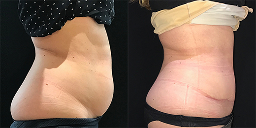 abdominoplasty before and after at Cosmetic Surgery Partners London