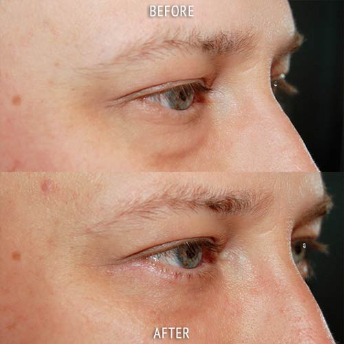 blepharoplasty surgery before and after patient results oblique angle view photo at Cosmetic Surgery Partners London