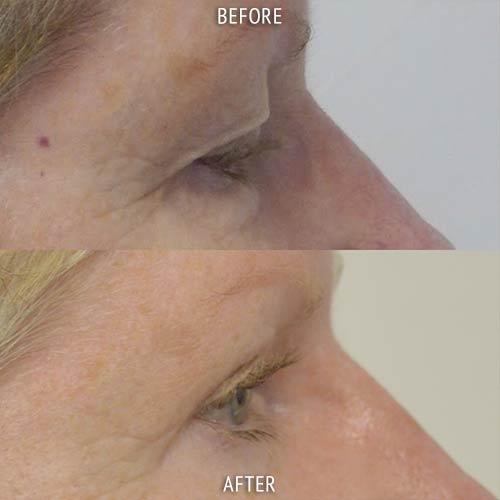 blepharoplasty surgery before and after patient results side view photo at Cosmetic Surgery Partners London