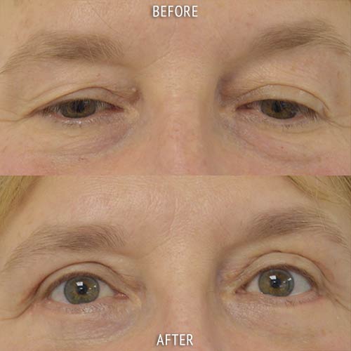 blepharoplasty surgery before and after patient results front view photo at Cosmetic Surgery Partners London