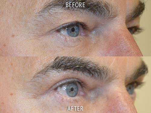 blepharoplasty surgery before and after patient results oblique angle view photo at Cosmetic Surgery Partners London