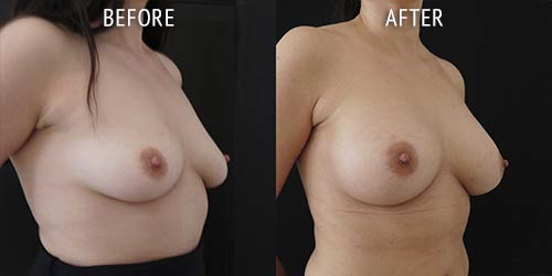 breast augmentation surgery before and after patient results oblique angle view photo at Cosmetic Surgery Partners London
