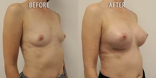 breast augmentation surgery before and after patient results oblique angle view photo at Cosmetic Surgery Partners London