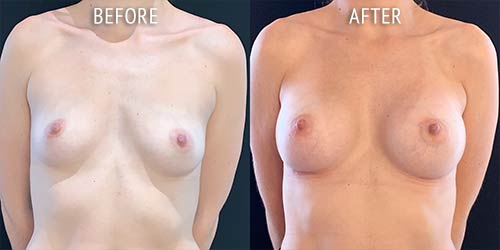 breast augmentation surgery before and after patient results front view photo at Cosmetic Surgery Partners London