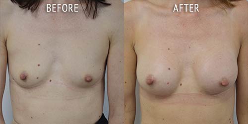 breast augmentation surgery before and after patient results front view photo at Cosmetic Surgery Partners London