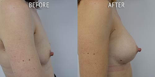 breast augmentation surgery before and after patient results side view photo at Cosmetic Surgery Partners London
