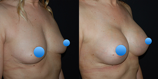 breast augmentation  before and after at Cosmetic Surgery Partners London