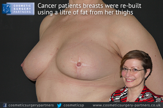 breast reconstruction using far donor post breast cancer