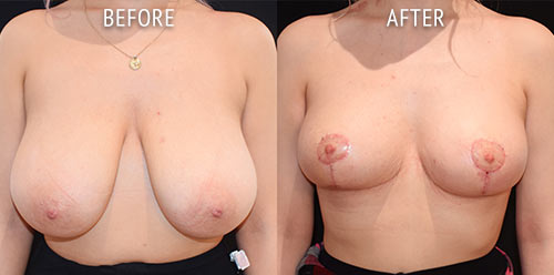 breast reduction surgery before and after patient results front view photo at Cosmetic Surgery Partners London