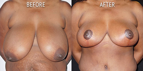 breast reduction surgery before and after patient results front view photo at Cosmetic Surgery Partners London