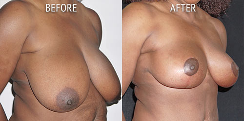 breast reduction surgery before and after patient results oblique angle view photo at Cosmetic Surgery Partners London