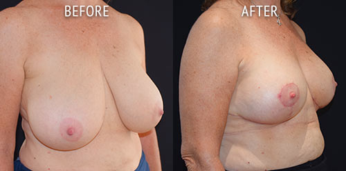 breast reduction surgery before and after patient results oblique angle view photo at Cosmetic Surgery Partners London