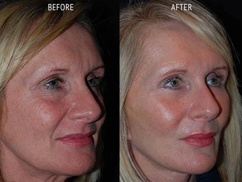 face lift surgery before and after patient results oblique angle view photo at Cosmetic Surgery Partners London